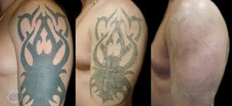 Beratung zur Tattooentfernung im Madame Beauty Institut