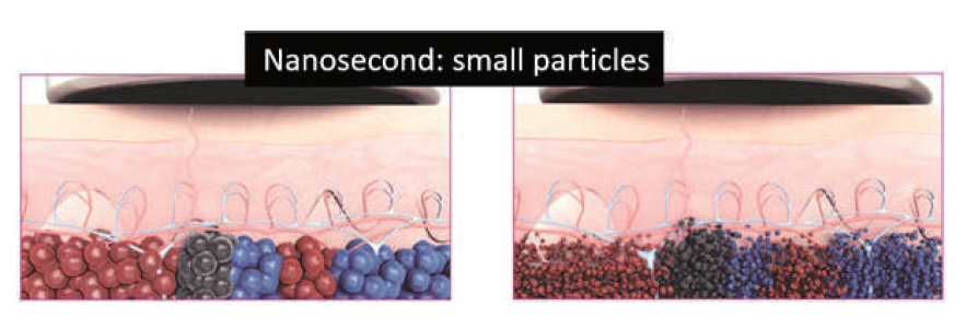 Vergleich Picolaser und Nanosekundenlaser bei der Tattooentfernung