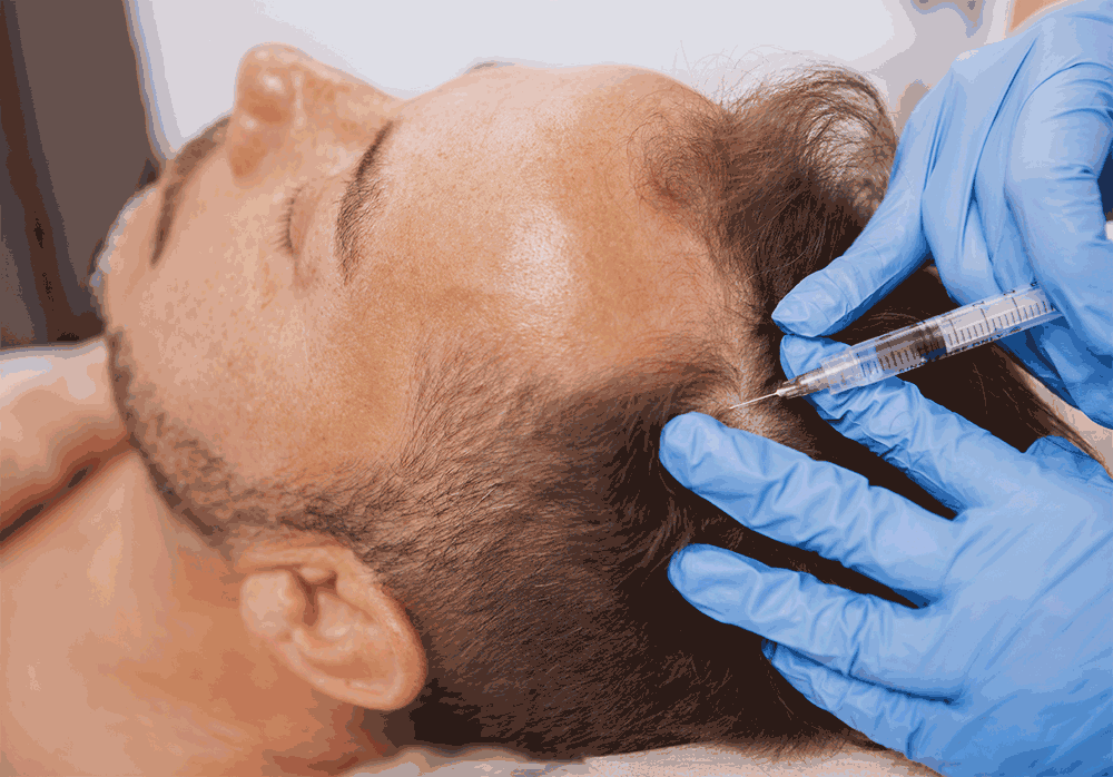 PRP Bern – Eigenbluttherapie gegen Haarausfall im Madame Beauty Institut