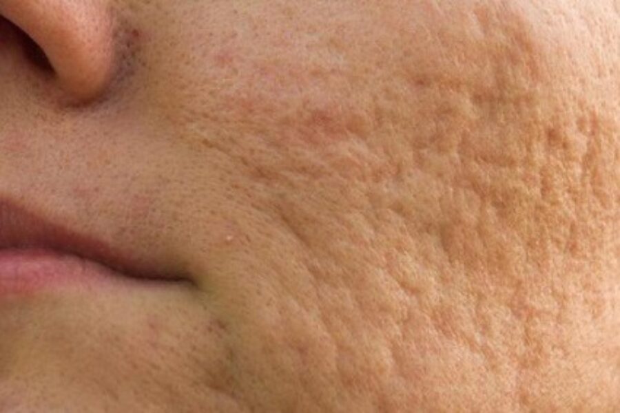 Aknenarben entfernen Bern – Laserbehandlung im Madame Beauty Institut