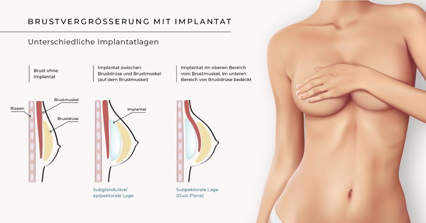 Brustvergrösserung in Bern – Implantat oder Eigenfett