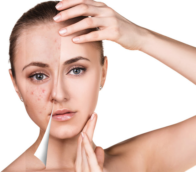 Microneedling Bern – Behandlung mit dem Needling Pen im Madame Beauty Institut