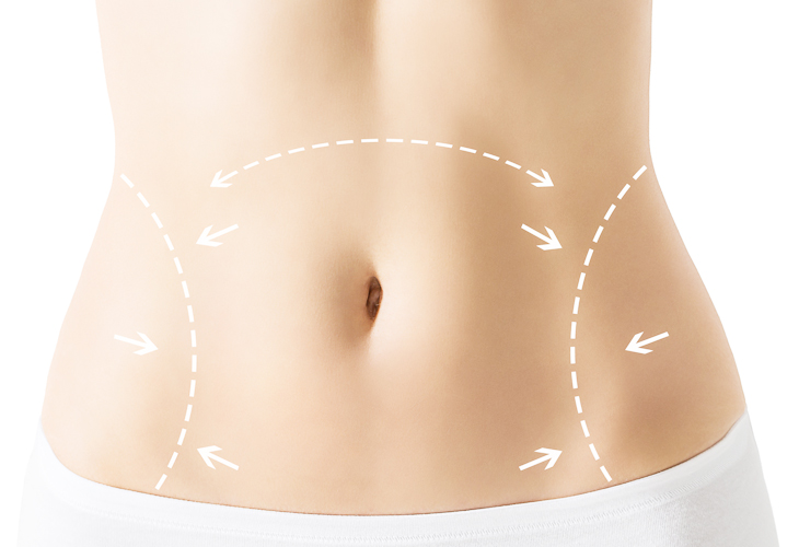 Bauchdeckenstraffung in Bern nach Gewichtsabnahme oder Schwangerschaft
