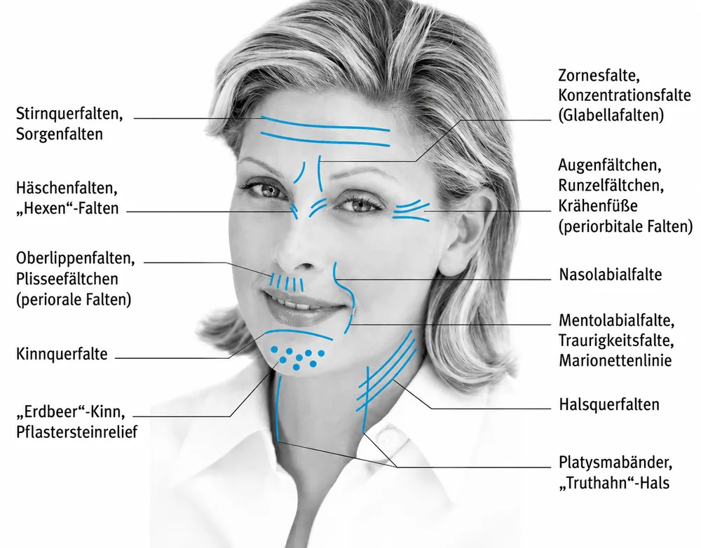 HIFU Bern – Faltenzonen im Gesicht: Stirnquerfalten, Zornesfalte, Krähenfüsse, Nasolabialfalte, Oberlippenfältchen, Marionettenlinie, Kinn- und Halsfalten