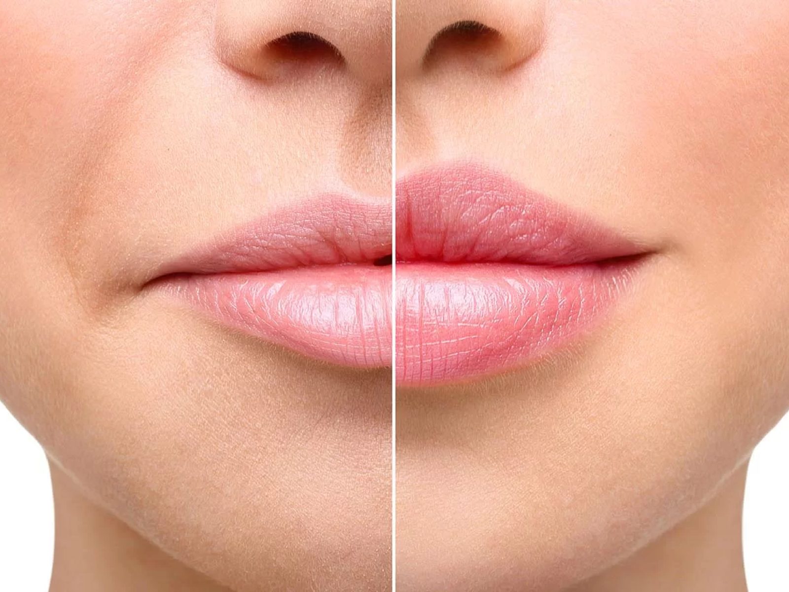 Liplift in Bern – Verkürzung der Oberlippe im Madame Beauty Institut an der Spitalgasse 36