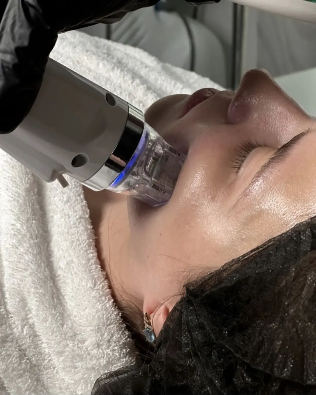 RF-Microneedling in Bern zur Straffung und Verdichtung der Haut