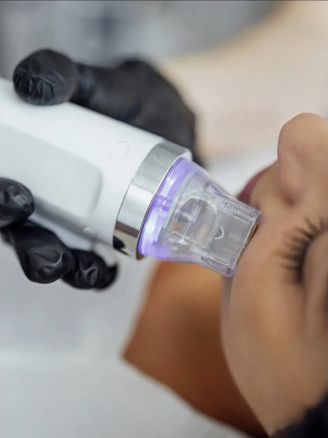 Microneedling mit Radiofrequenz Bern – Behandlung im Madame Beauty Institut