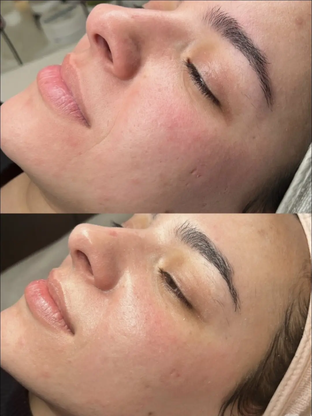 RF-Microneedling in Bern – Verbesserung der Hautstruktur über mehrere Sitzungen