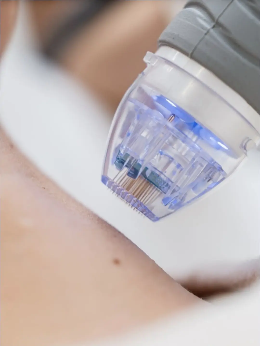 Microneedling mit Radiofrequenz Bern – Nadelaufsatz aus der Nähe