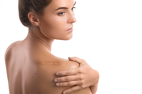 Hautstruktur und Narben behandeln in Bern – Microneedling und Laser im Madame Beauty Institut