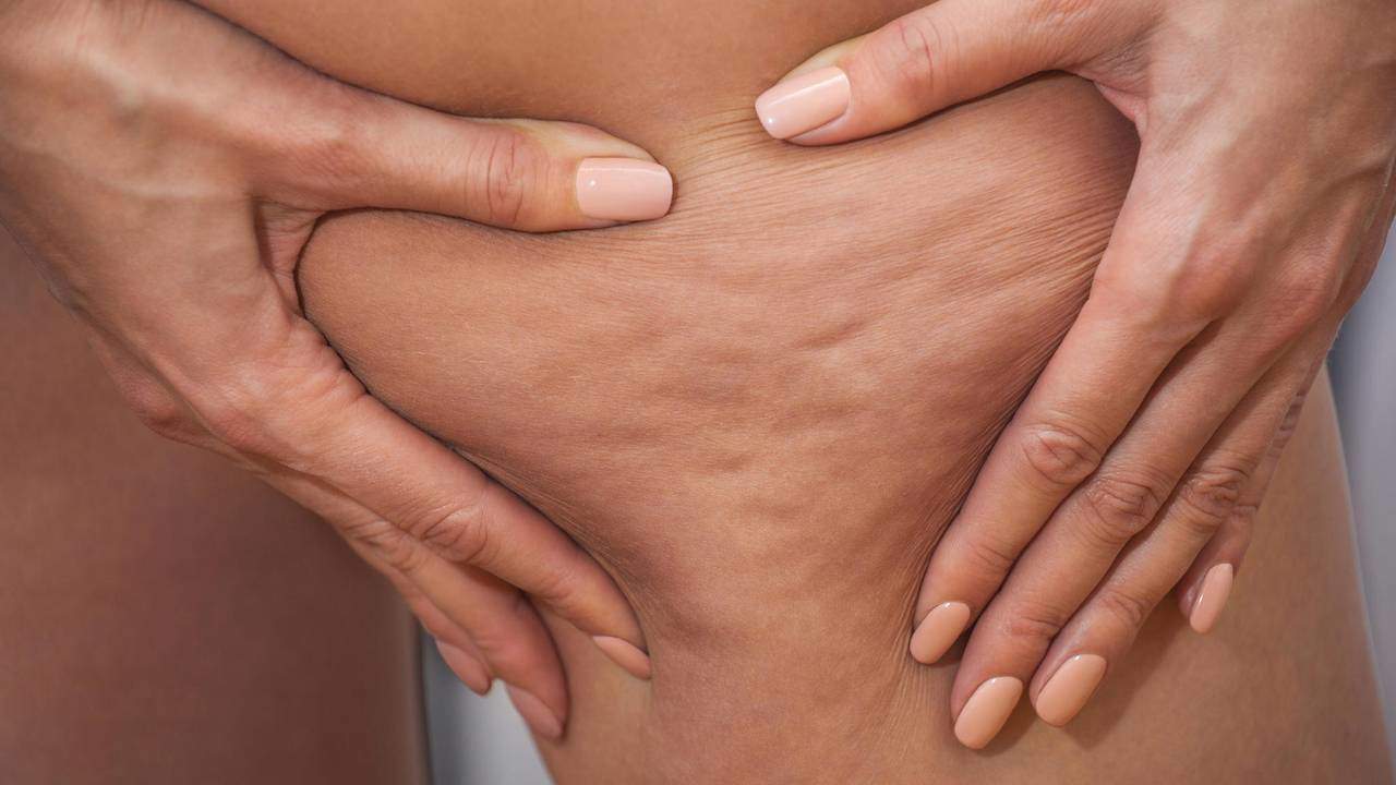 Cellulite Behandlung Bern