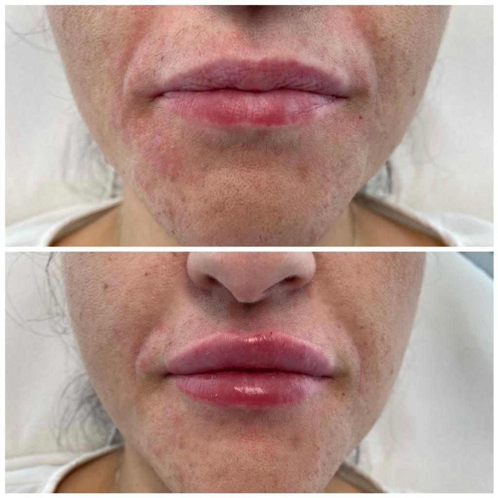 Lippenvergrösserung mit Hyaluron im Madame Beauty Institut Bern