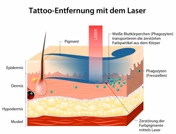 Tattooentfernung in Bern Ablauf. Jetzt mehr erfahren.