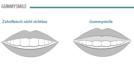 Gummy Smile Behandlung in Bern. Jetzt mehr erfahren.