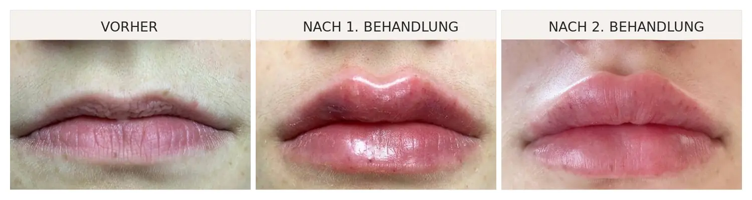 Lippen aufspritzen Bern – vorher, nach der ersten und nach der zweiten Behandlung drei Monate später