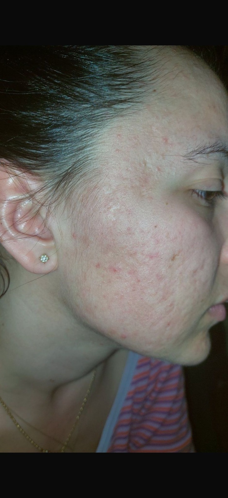 Aknenarben linke Wange nachher – Nachsorge mit IESKIN G9 Cream