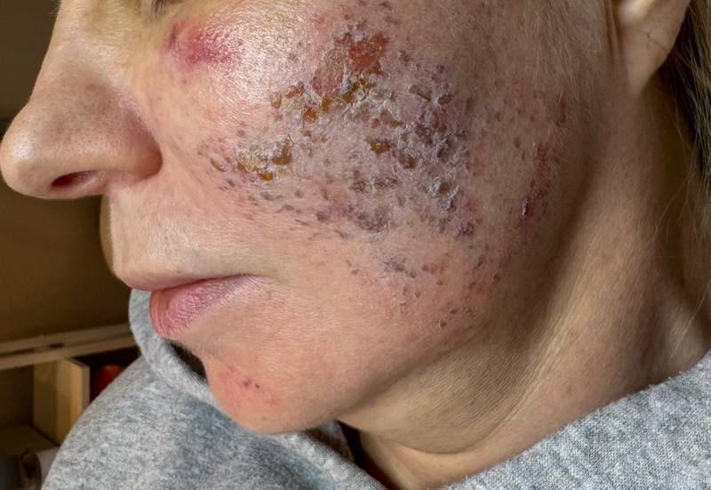 Wange in der Abheilphase nach Behandlung – Bild 2