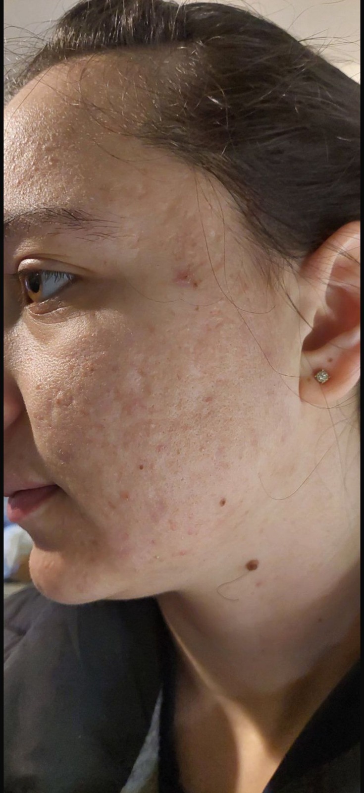Aknenarben rechte Wange nachher – Nachsorge mit IESKIN G9 Cream