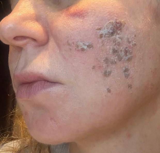 Wange in der Abheilphase nach Behandlung – Bild 1