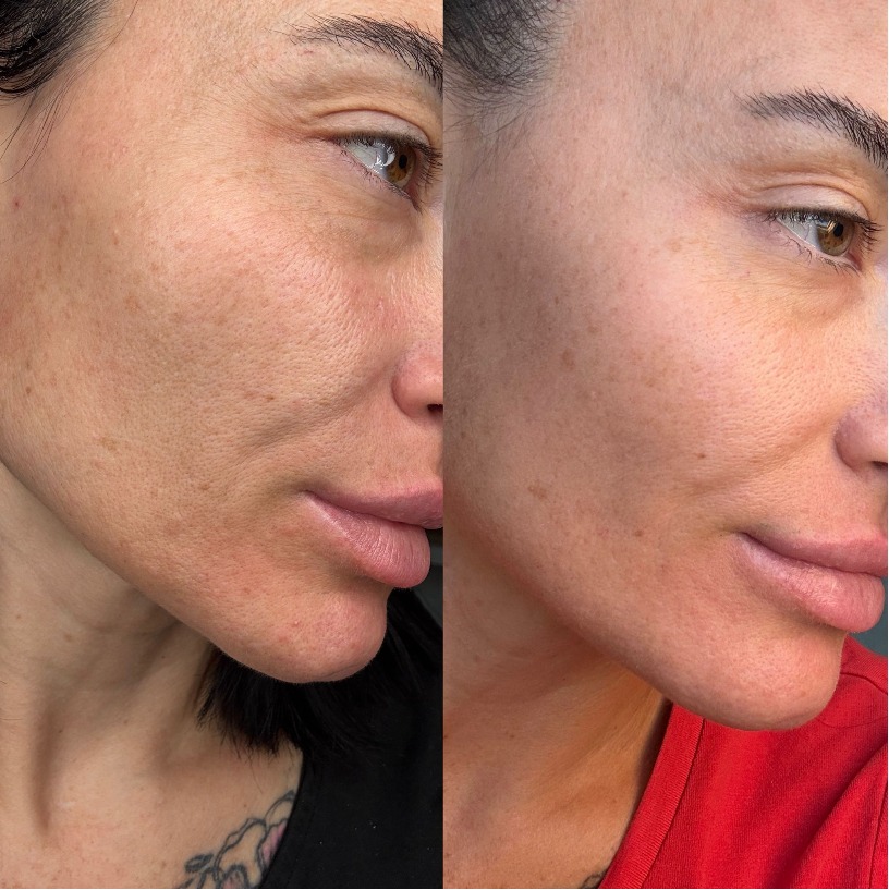 Vorher nachher Wange – Nachsorge mit IESKIN G9 Cream