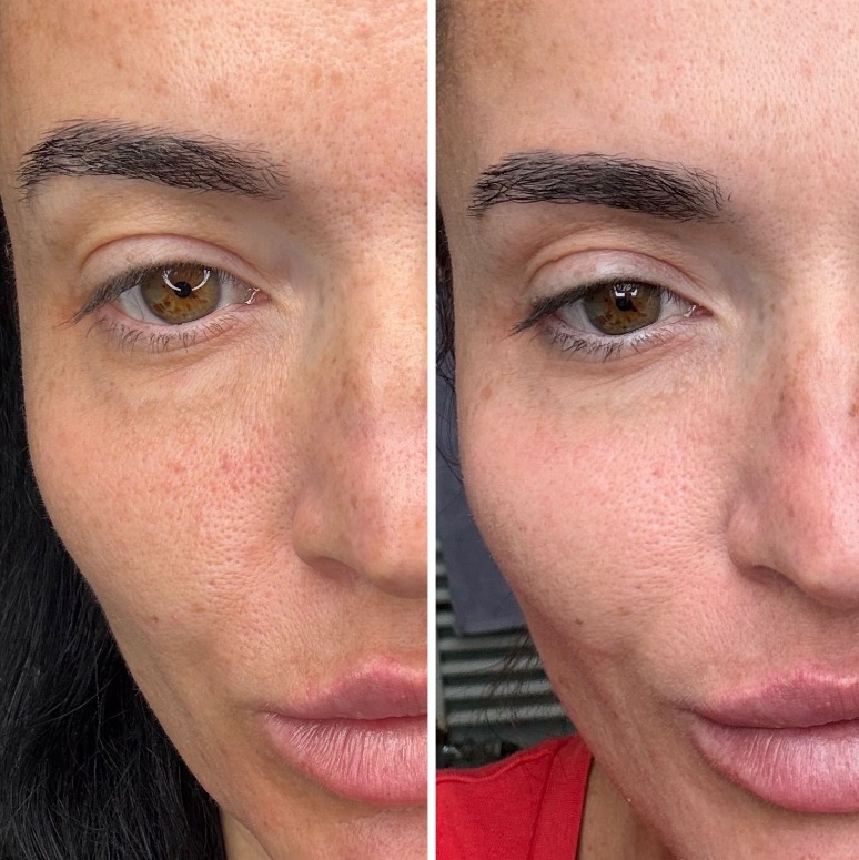 Vorher nachher Augenpartie – Nachsorge mit IESKIN G9 Cream